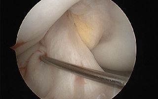 Артроскопия крестообразных связок коленного сустава