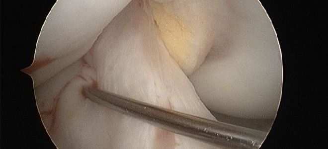 Артроскопия крестообразных связок коленного сустава