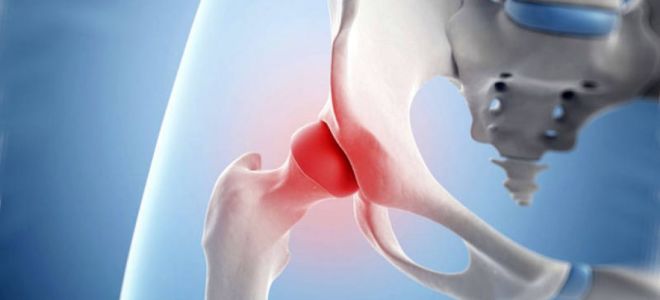 Воспаление и повреждение связок тазобедренного сустава