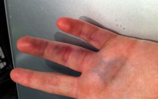 Симптомы и лечение перелома мизинца на руке