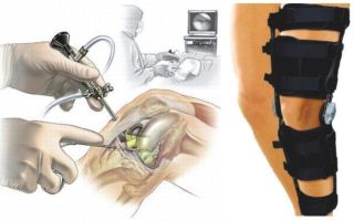 Операция на связки коленного сустава