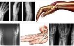 Признаки перелома лучевой кости руки и методы лечения