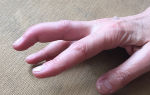 Разрыв связок и сухожилий на пальцах руки