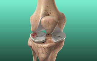 Разрыв латерального мениска коленного сустава