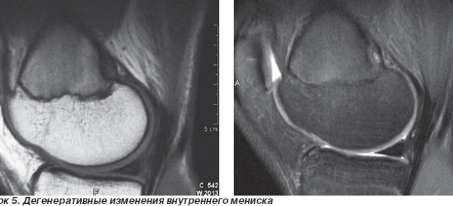 Дегенеративные изменения крестообразных связок коленного сустава