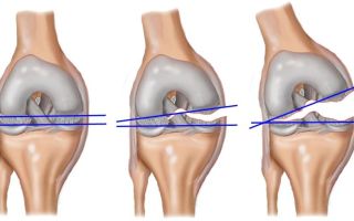 Симптомы и лечение растяжения связок коленного сустава