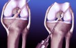 Восстановление крестообразных связок колена