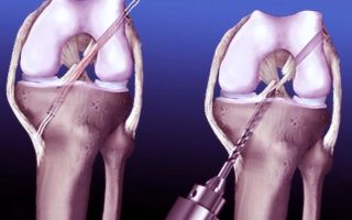 Восстановление крестообразных связок колена