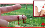 Остановка кровотечения при порезе пальца