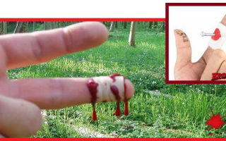 Остановка кровотечения при порезе пальца