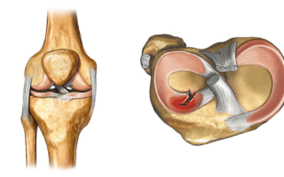Повреждения мениска коленного сустава