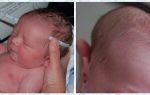 Лечение гематомы на голове у новорожденного