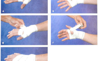 Симптомы перелома пальца руки, оказание первой помощи и лечение