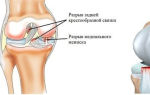 Травмы задней крестообразной связки коленного сустава
