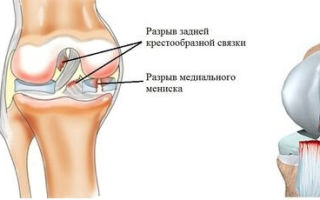 Травмы задней крестообразной связки коленного сустава