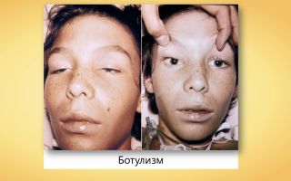 Ботулизм — клиническая картина и лечение заболевания