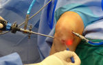 Операции по восстановлению связок коленного сустава
