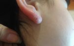 Симптомы и лечение обморожения ушей