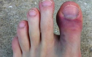 Симптомы и лечение перелома большого пальца на ноге
