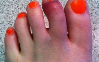 Симптомы и лечение вывиха пальца на ноге