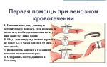 Первая помощь при венозном кровотечении