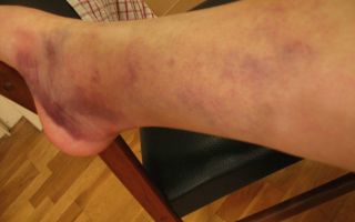 Лечение гематомы на ноге после ушиба или других травм