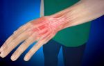 Симптомы и лечение растяжения связок кисти руки