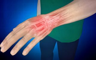 Симптомы и лечение растяжения связок кисти руки
