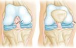 Повреждения крестообразных связок коленного сустава