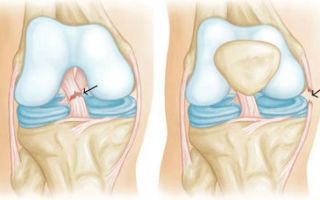 Повреждения крестообразных связок коленного сустава