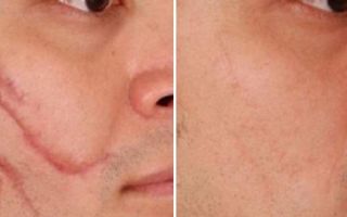 Методы удаления шрамов на лице и теле