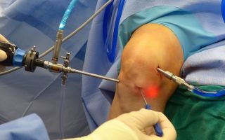 Реабилитация после разрыва мениска коленного сустава