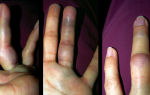 Симптомы и лечение вывиха пальца на руке