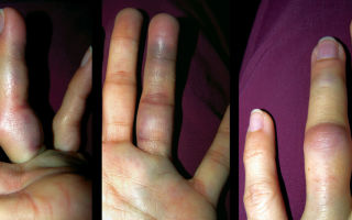 Симптомы и лечение вывиха пальца на руке