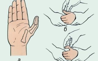 Симптомы и лечение вывиха большого пальца на руке