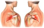 Надрыв и разрыв связок плечевого сустава