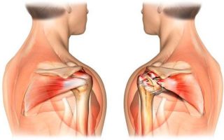 Надрыв и разрыв связок плечевого сустава