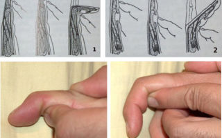Разработка пальцев руки после повреждения сухожилий