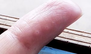Маленькие водянистые пузырьки на пальцах рук