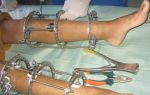 Использование аппарата илизарова при травмах рук и реабилитация после его снятия