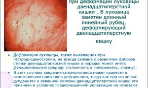 Симптомы и лечение рубцовой деформации луковицы дпк