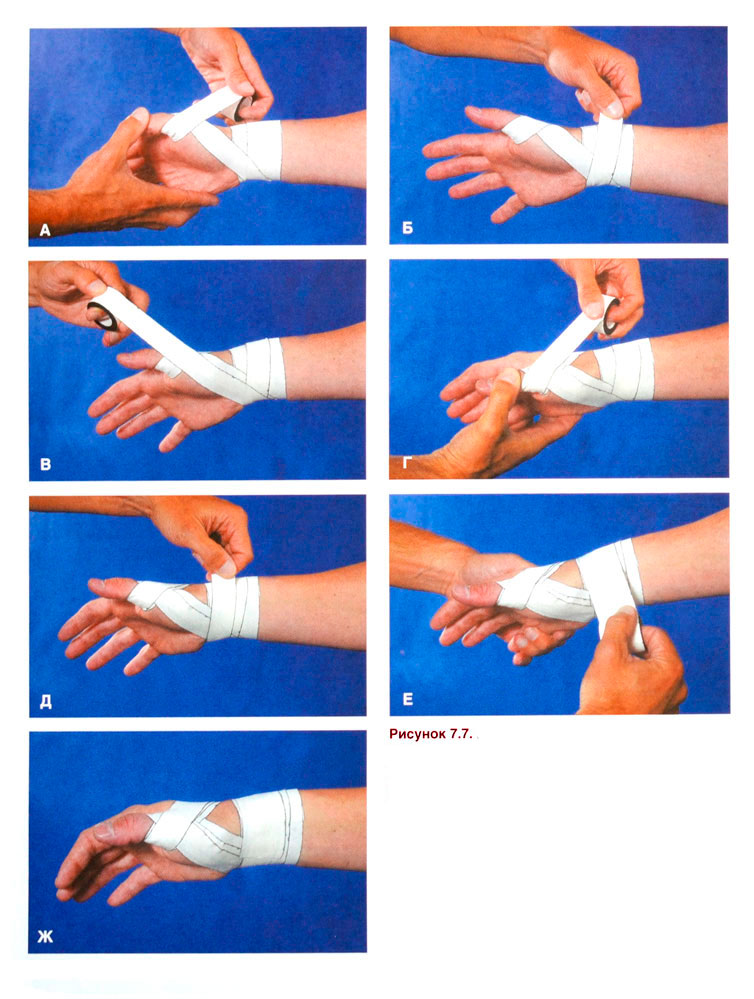 Реабилитация кисти после операции. Перевязка большого пальца. Повязка при ушибе пальца на руке. Перебинтованный большой палец на руке.