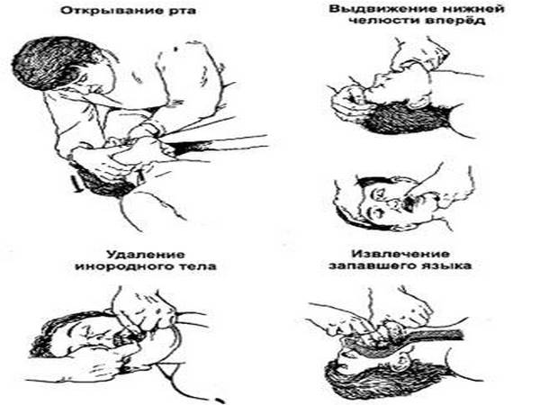 Первое помощь при асфиксия. Алгоритм оказания первой помощи при асфиксии. Алгоритм оказания помощи при удушении. Первая помощь при клапанной асфиксии. Алгоритм оказания первой помощи при удушении.